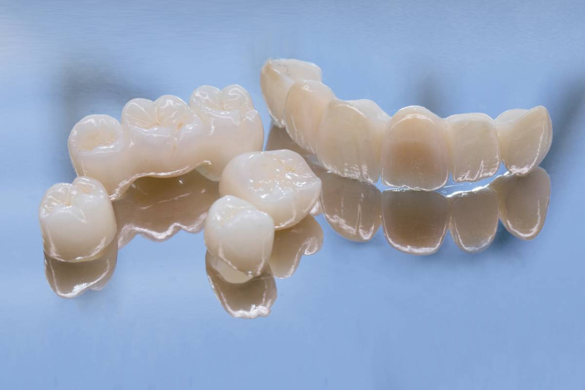featured image for are dental crowns customized