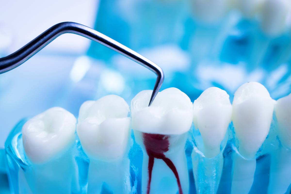 concept of what to do if your root canal fails